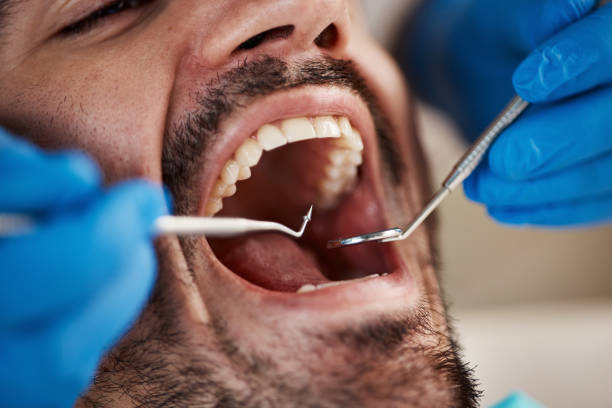 Best Chipped Tooth Repair Near Me  in The Acreage, FL